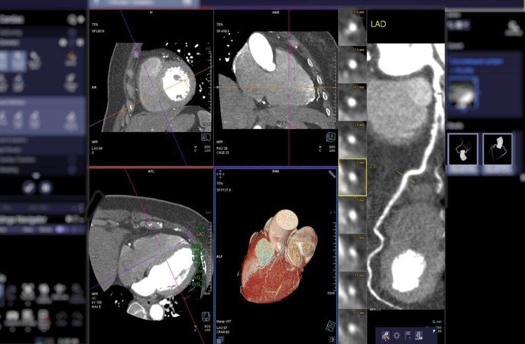 Coronary Artery CT Angiogram