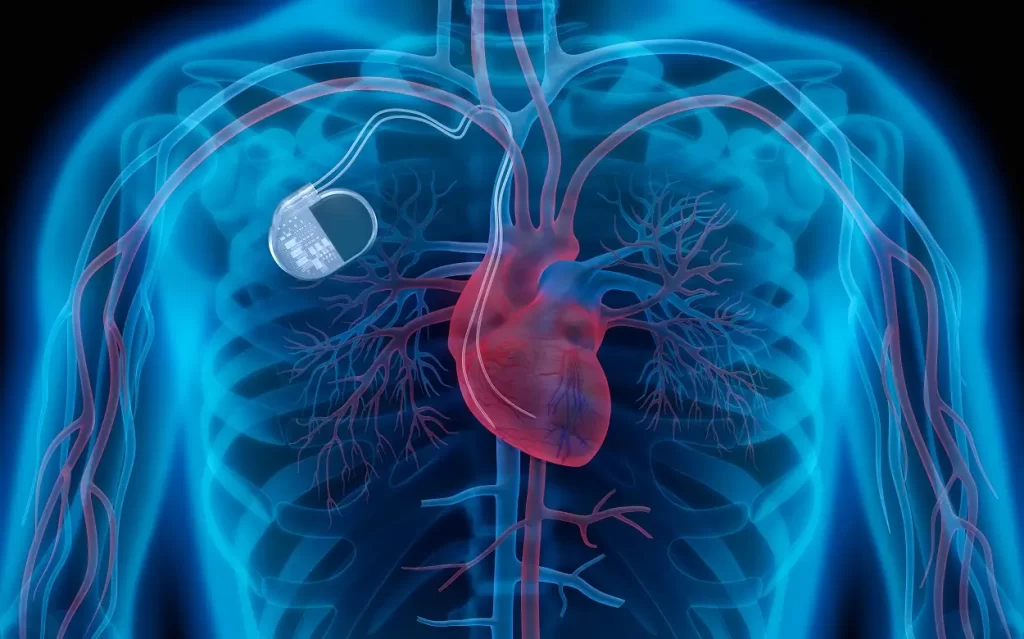 Permanent Pacemaker