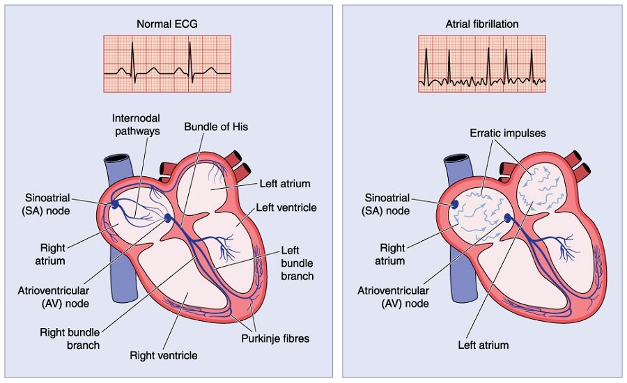 Diagram Of Atrial Fibrillation At Brad Schaffer Blog Diagram Of Atrial Fibrillation At Brad Schaffer Blog