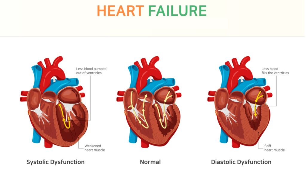 Examples Of Diastolic Heart Failure