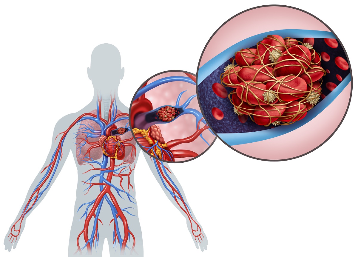 Pulmonary Embolism What Is It