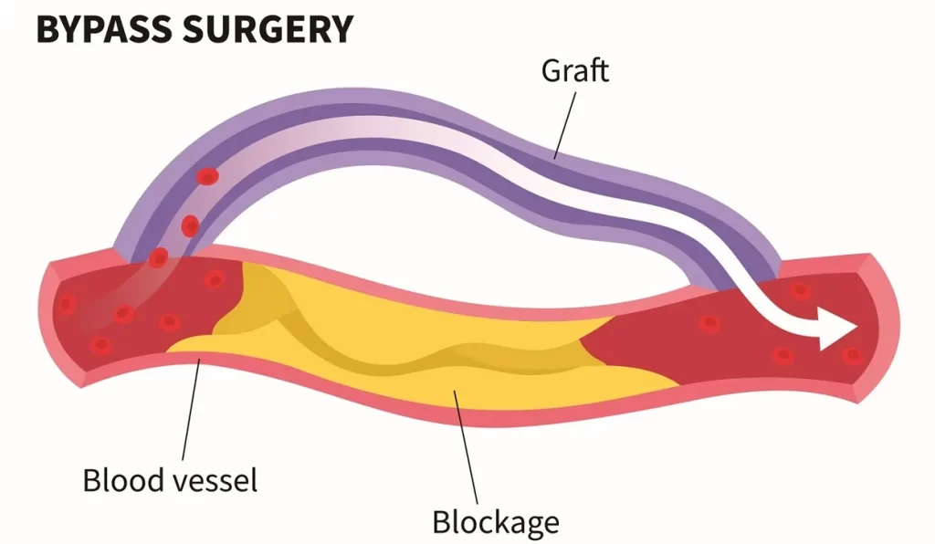 Coronary Artery Bypass Grafting (CABG)