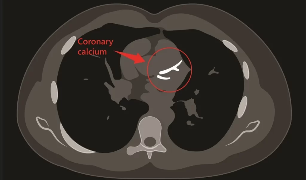 Coronary Calcium Score